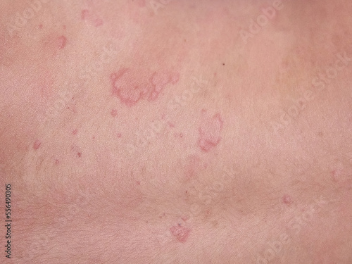 food allergy. a boy with red spots. The child has itching, with an allergic rash..