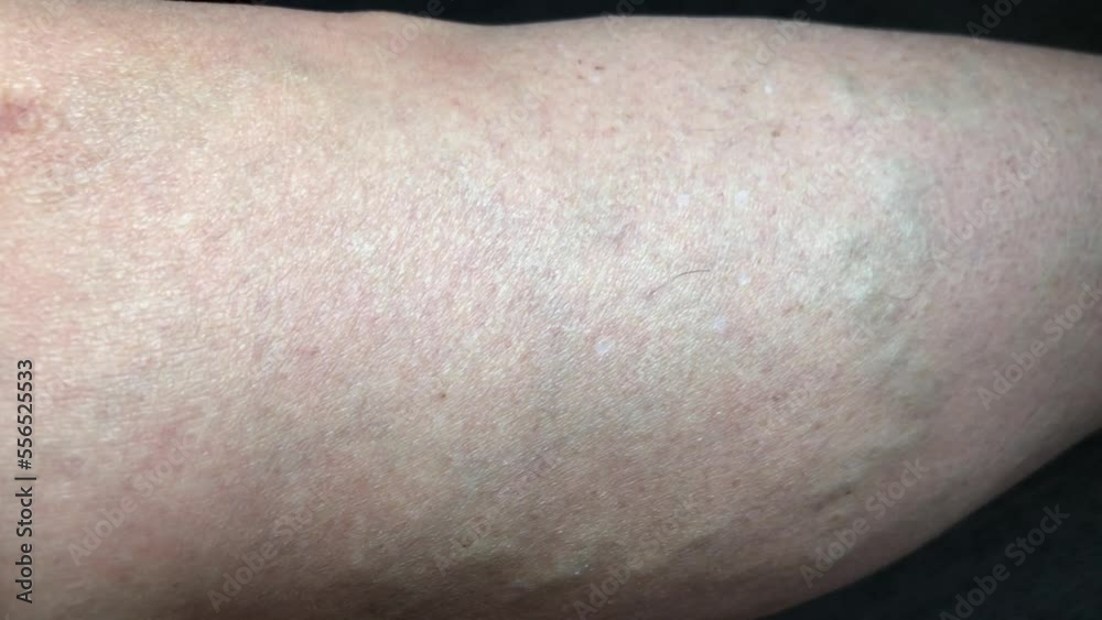 Varicose veins of the leg