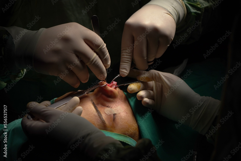 rhinoplasty surgery, defects in the shape of the nose in the female patient. Surgical intervention in plastic surgery rhinoplasty 