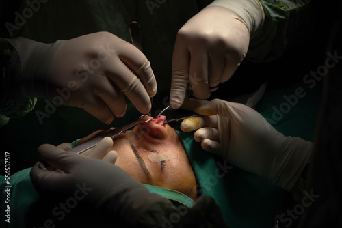 Foto rhinoplasty surgery, defects in the shape of the nose in the female patient