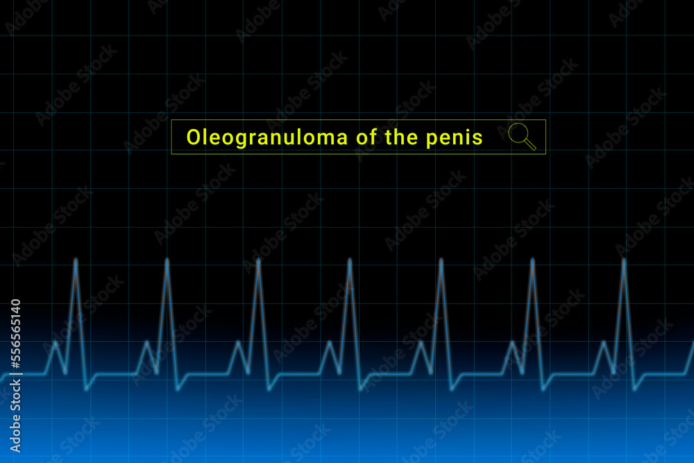 Oleogranuloma of the penis.Oleogranuloma of the penis inscription in search bar. Illustration with titled Oleogranuloma of the penis . Heartbeat line as a symbol of human disease. Oleogranuloma of the penis.Oleogranuloma of the penis inscription in search bar. Illustration with titled Oleogranuloma of the penis . Heartbeat line as a symbol of human disease.