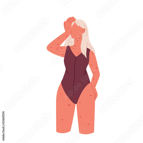 Rash on the skin. Autoimmune disease, chickenpox, atopic dermatitis. A woman has a rash. Flat vector illustration