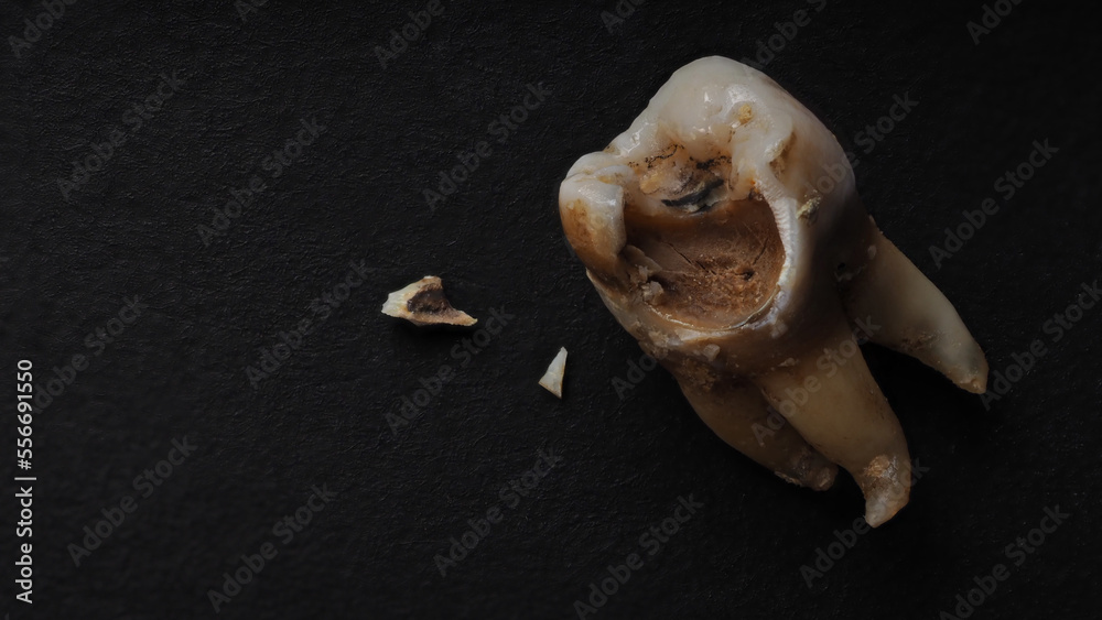 Naklejka premium Tooth decay on black background. Macro shot of a decayed teeth till root after extraction of dentist. Real tooth anatomy due lack of care. Top view of caries teeth texture on black paper. Dental care.