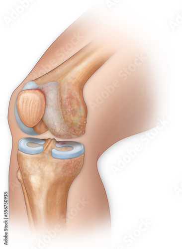 Medial view three quarter knee bent with injuries: Torn meniscus, arthritis, eburnation, and microfracture photo
