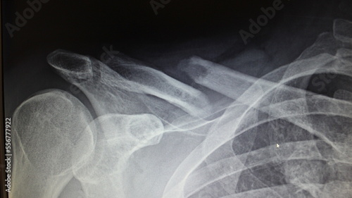 X ray of a broken collarbone/clavicle