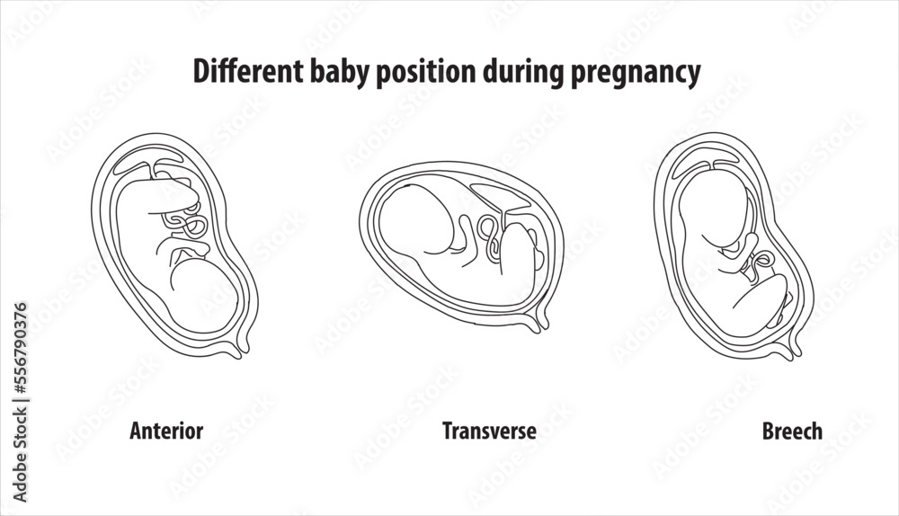 Different baby position during pregnancy. Anterior, transverse, breech