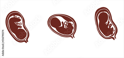 Different baby position during pregnancy. Anterior, transverse, breech. Design for health care, education
