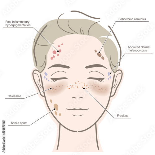 Diagram of women's facial age spots. Vector illustration isolated on white background.