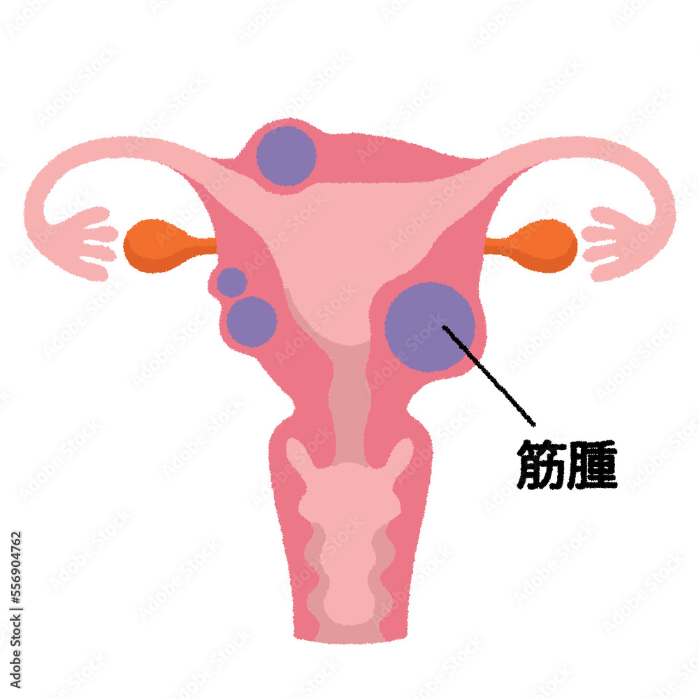 子宮筋腫のイラスト Stock Illustration Adobe Stock