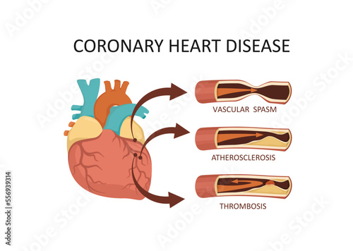 Coronary heart disease. Heart attack - atherosclerosis, thrombus, spasm,