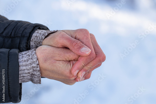 Women's frozen hands in the cold.Women's hands with dry skin and red fingers in the cold in winter.The concept of skin care in winter.