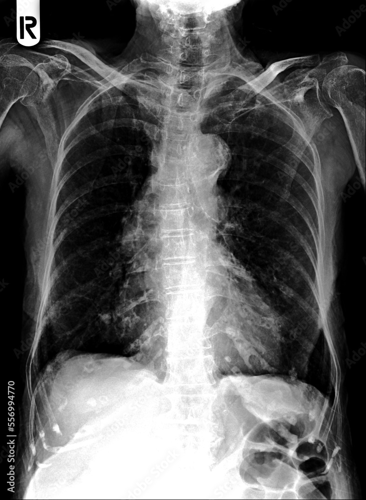 Film chest x-ray show alveolar infiltrate at left middle lung Film chest x-ray show alveolar infiltrate at left middle lung