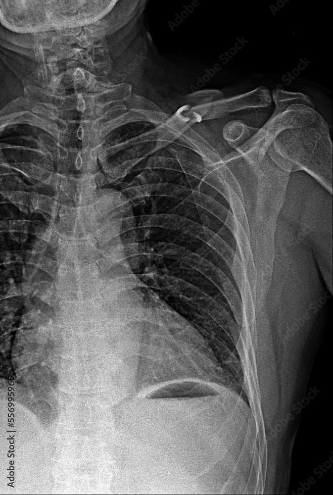Film x-ray clavicle AP show fracture clavicle bone Film x-ray clavicle AP show fracture clavicle bone