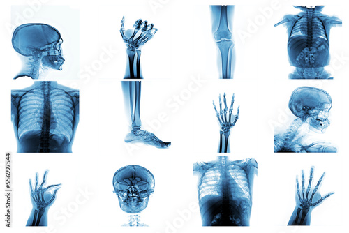 X-ray multiple part of human and many medical condition and disease