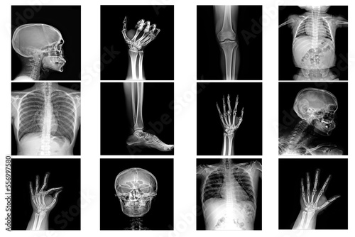 X-ray multiple part of human and many medical condition and disease