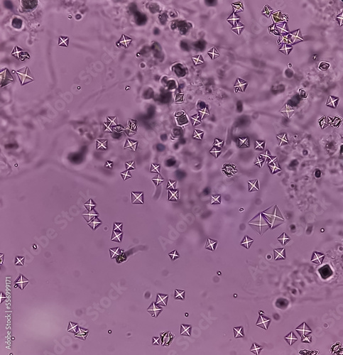 Photos Microscopic image showing Calcium oxalate crystals from urine sediment, most common cause of kidney stones