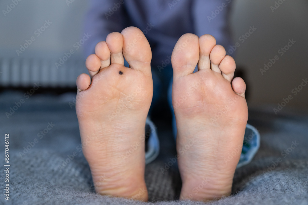 Man shows two feet. One with healthy skin, second with plantar wart ...