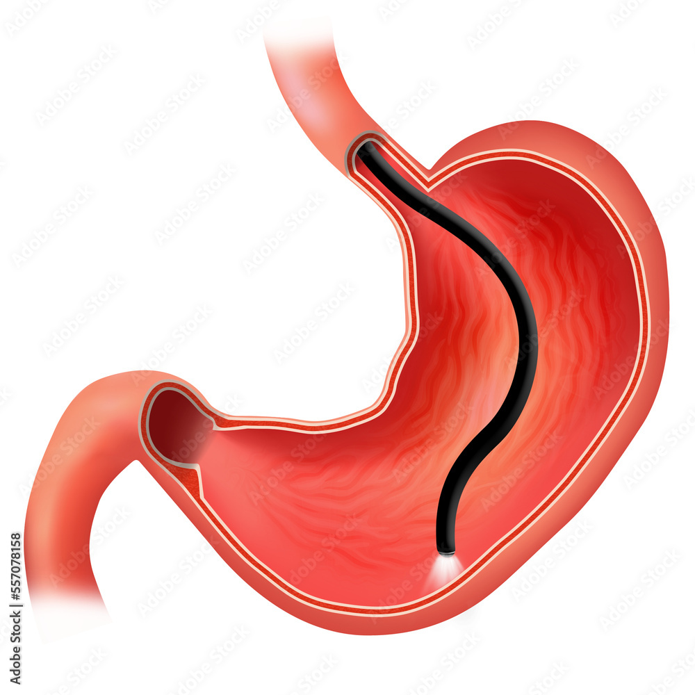 Endoscopic biopsy, esophagogastroduodenoscopy, EGD. Human stomach. Medical care for stomach