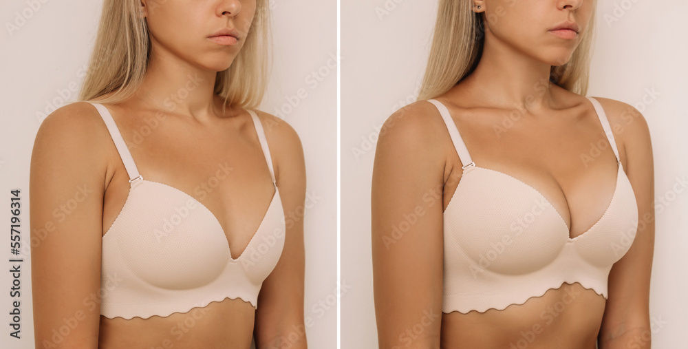 Young tanned blonde woman in bra before and after breast augmentation with  silicone implants. The result of a breast lift. Breast size correction  isolated on beige background. Plastic surgery concept Stock-bilde