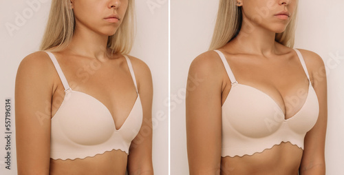 Young tanned blonde woman in bra before and after breast augmentation with silicone implants. The result of a breast lift. Breast size correction isolated on beige background. Plastic surgery concept