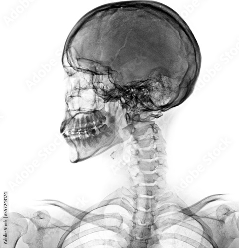 Skull lateral view x ray