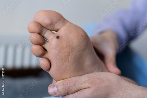 Man checks wart at home after cauterizing it with celandine on infected foot. Human papillomavirus or HPV. Verrucas papilloma callus virus. Viral skin infection concept. 