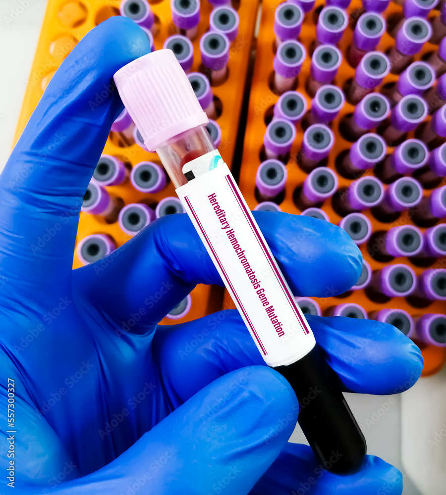 Blood sample for Heriditary Hemochromatosis gene mutation test, a