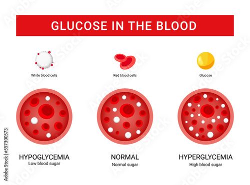 Glucose blood infographic, glucose stages design concept