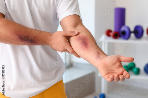 Sporty man with bruises on body training in gym, closeup