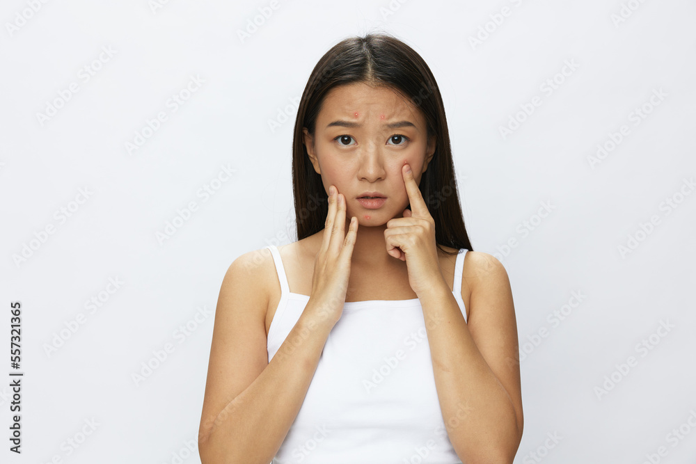 Asian woman facial skin problems, acne and inflammation, red rashes and allergies, chicken pox, sadness from rashes. Facial skin care concept for diseases and nerves Asian woman facial skin problems, acne and inflammation, red rashes and allergies, chicken pox, sadness from rashes. Facial skin care concept for diseases and nerves