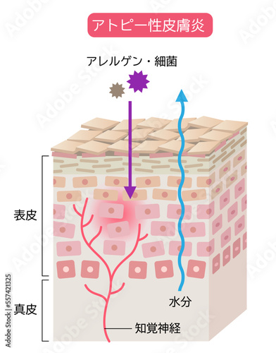 アトピー性皮膚炎のしくみ　肌細胞と断面図　立体