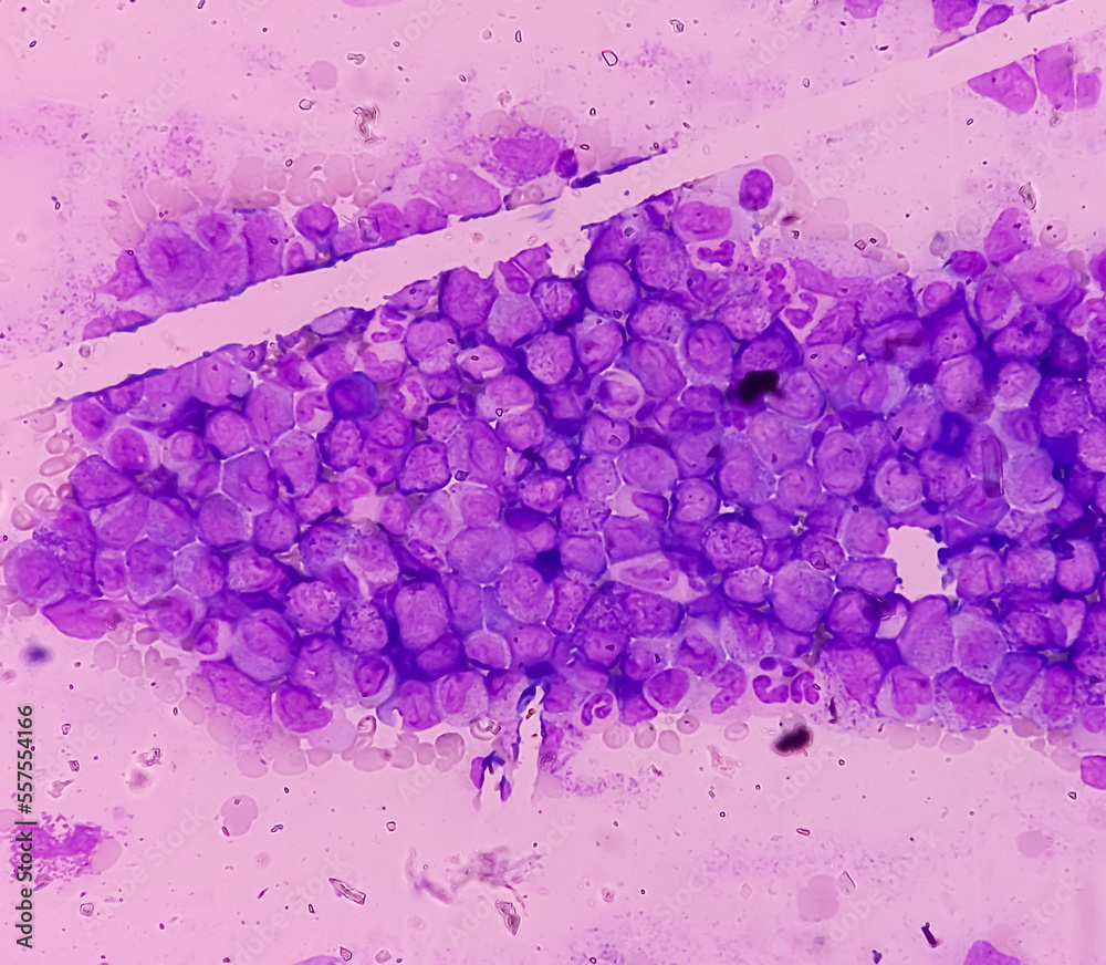 chronic-myeloid-leukemia-or-cml-chronic-phase-with-microcytic