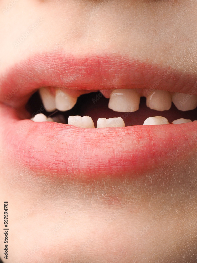 closeup of a child's baby teeth that have fallen out. mouth and lips