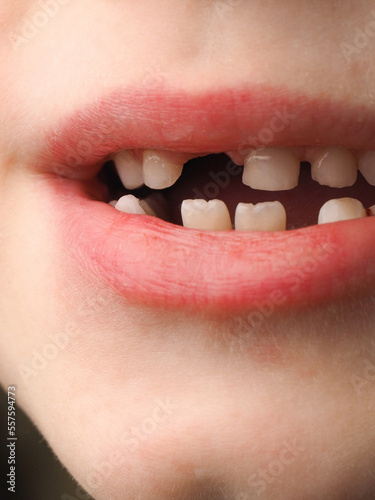 close-up of a child's baby teeth that have fallen out. mouth and lips with missing and new molars. Toddler changing teeth. medicine and dentistry.