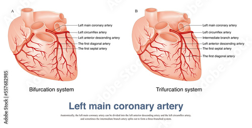 Fotobehang The left main coronary artery can be divided into the left anterior descending artery and the left circumflex artery, and sometimes the intermediate branch artery