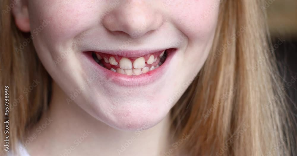 The girl smiles and shows her teeth. Baby teeth in a child The girl smiles and shows her teeth. Baby teeth in a child