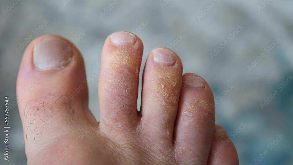 calluses and fungus on the toes, foot fungal diseases, itchy foot