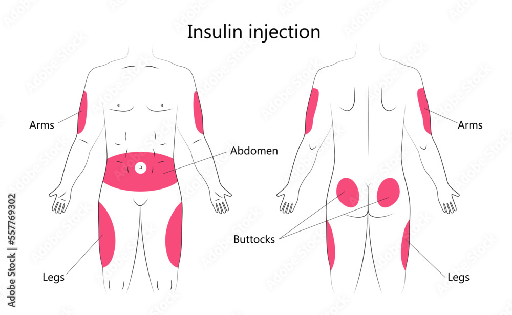 Insulin injection infographic vector. Diabetes treatment and insulin