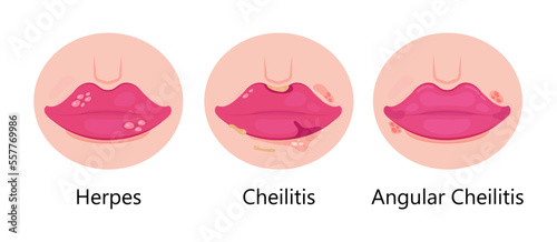 Herpes lips vector. Simplex virus infection causes recurring episodes of small, painful, fluid-filled blisters on skin, mouth, lips.