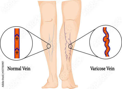 Varicose veins. Image of healthy and diseased legs. A longitudinal section of a vein with a description of the main parts. Vector illustration in flat style
