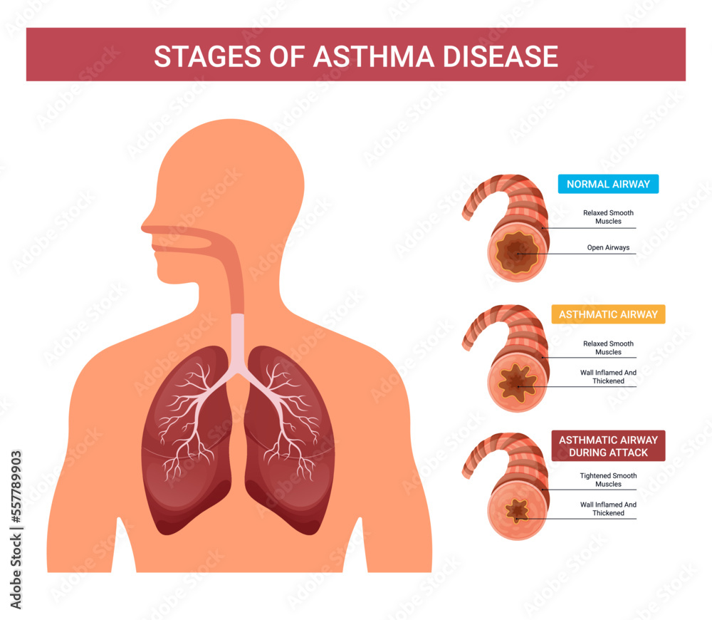 Asthma infographics, vector stages of human asthma Stock Vector Adobe