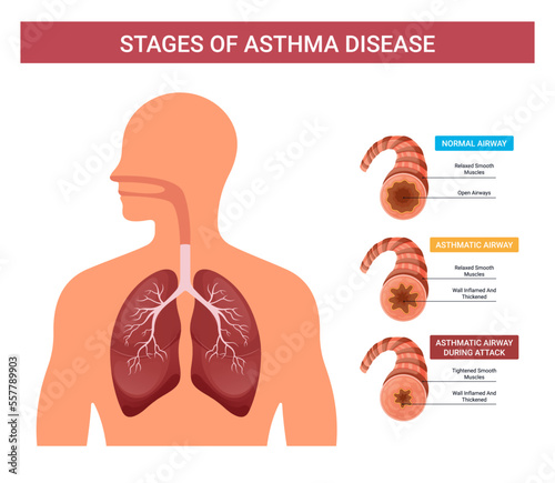 Asthma infographics, vector stages of human asthma