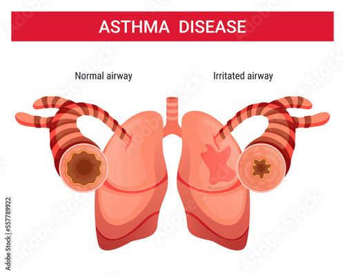 Asthma vector illustration ,asthma infographic