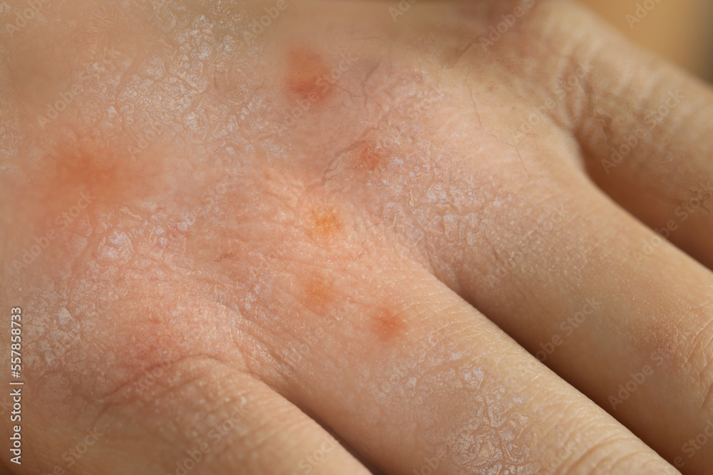 Closeup view of person with dry skin on hand Closeup view of person with dry skin on hand