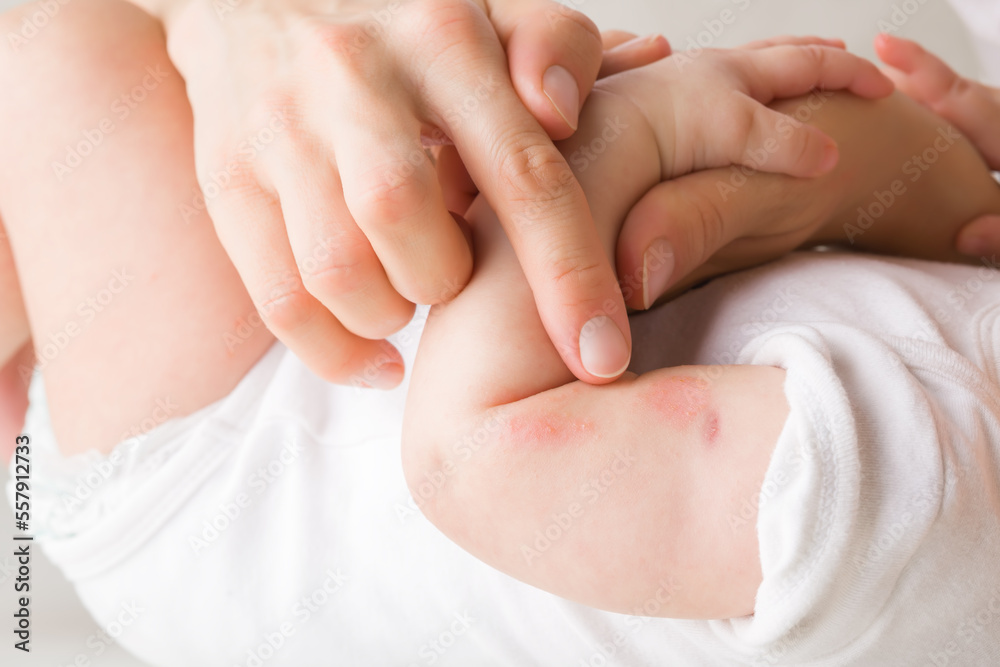 Young adult mother finger pointing to newborn arm with red rash. Allergy from milk formula or mother milk. Baby skin problem. Closeup. Side view. Young adult mother finger pointing to newborn arm with red rash. Allergy from milk formula or mother milk. Baby skin problem. Closeup. Side view.