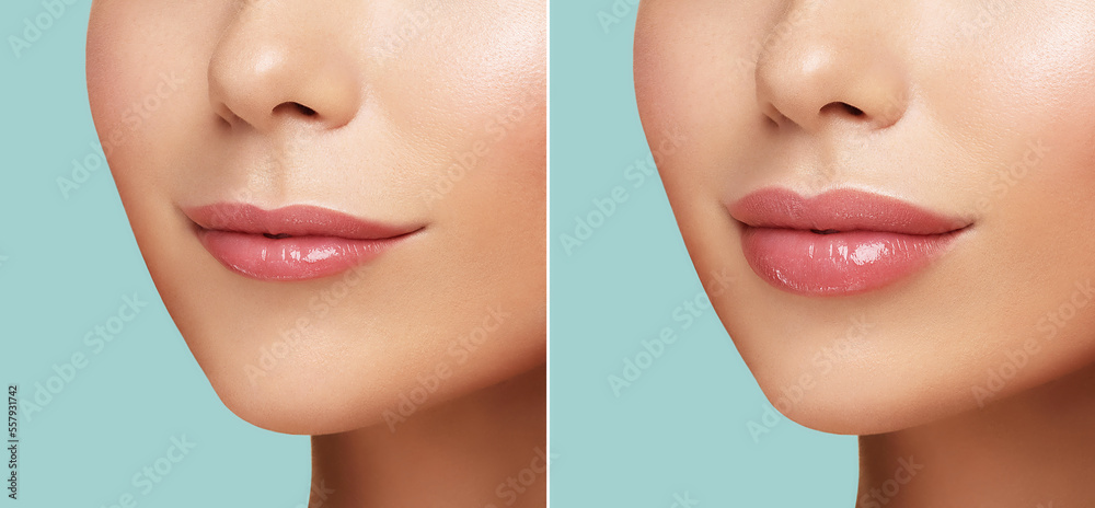 Comparison of Women lips correction before and after Hyaluronic acid injection. Injected and non-injected lips. Beauty lip treatment procedure. Natural lips shape. Lips Augmentation - obrazy, fototapety, plakaty 