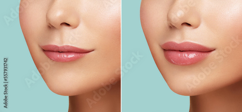 Comparison of Women lips correction before and after Hyaluronic acid injection. Injected and non-injected lips. Beauty lip treatment procedure. Natural lips shape. Lips Augmentation