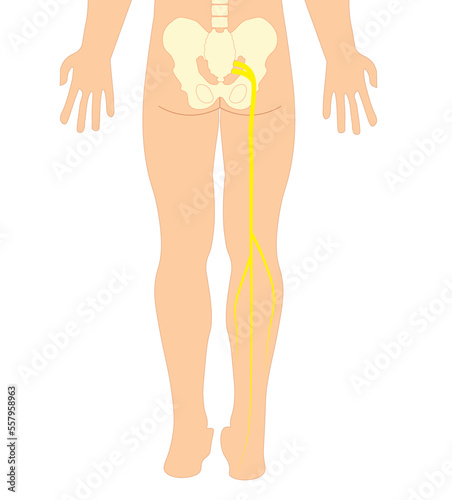 Sciatica - sciatic nerve Pain illustration in the right leg  photo