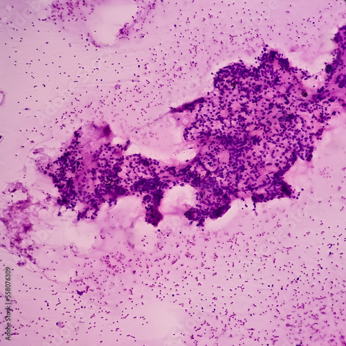 Thyroid nodule (FNA cytology): Cellular follicular lesion, microscopic show cellular material of regular thyroid follicular epithelial cells, background show histiocytes and blood. photo
