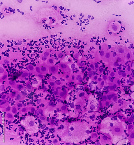 Pap's smear. Reactive cellular changes associated with severe inflammation. Atrophic changes(Bethesda cervical reporting system). Cervical cancer screening. Abnormal squamous epithelial cells. photo